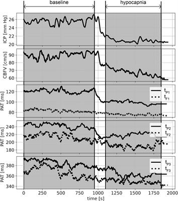 Peak appearance time in pulse waveforms of intracranial pressure and cerebral blood flow velocity